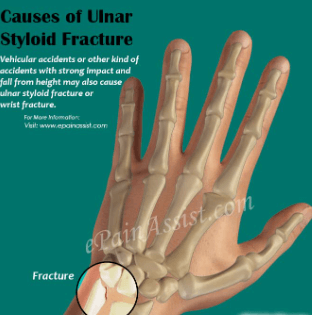 ulnar styloid fracture