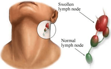 can allergies cause swollen lymph nodes