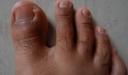 peroxide on toenail fungus