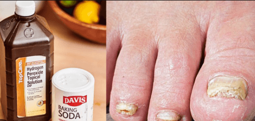 toenail fungus peroxide