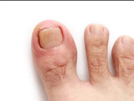 is nail fungus contagious