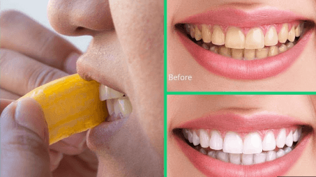 banana teeth whitening
