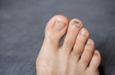 is toenail fungus contagious