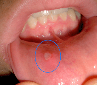 canker sore vs cancer of the mouth