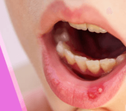 oral cancer vs canker sore