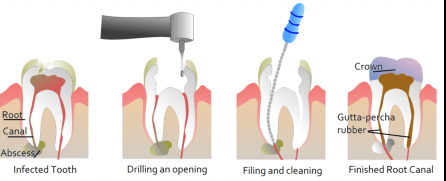 how does a dentist kill a nerve in your tooth