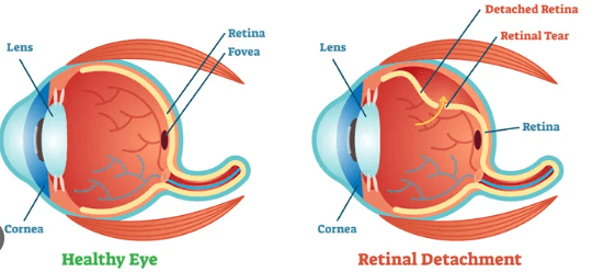 retinal detachment surgery cost