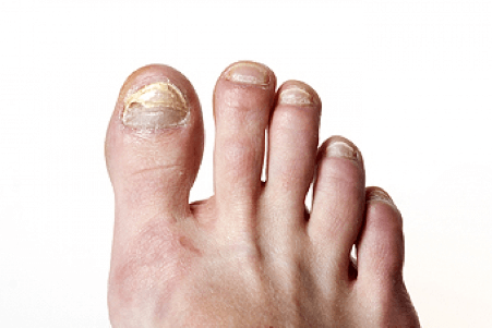 is foot fungus contagious