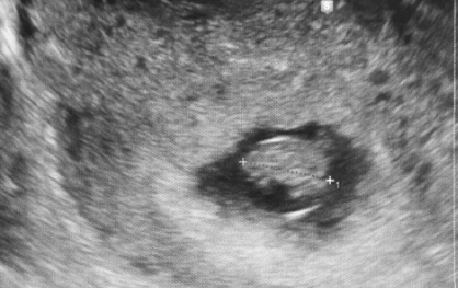 7 weeks pregnant ultrasound