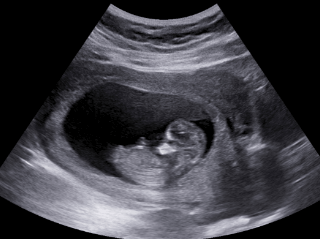 10 weeks pregnant ultrasound