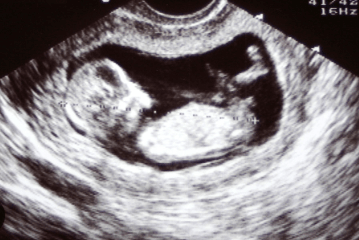 12 weeks pregnant ultrasound