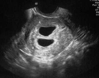 4 weeks pregnant ultrasound