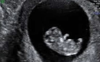 7 week ultrasound pictures