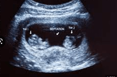 6 week ultrasound pictures