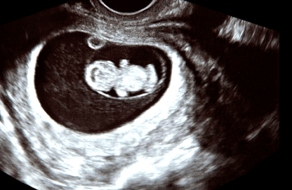 9 week ultrasound pictures