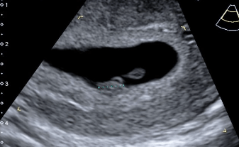 ultrasound 6 weeks pregnant