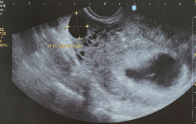 5 week ultrasound pictures