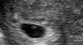ultrasound at 5 weeks