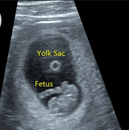 ultrasound at 8 weeks