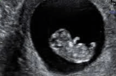 10 week ultrasound pictures