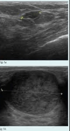 fibroadenoma vs cancer ultrasound