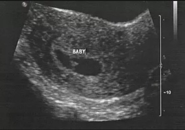 4 week ultrasound pictures