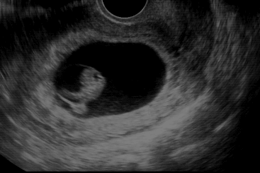 2 months pregnant ultrasound