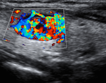thyroid cancer ultrasound colors