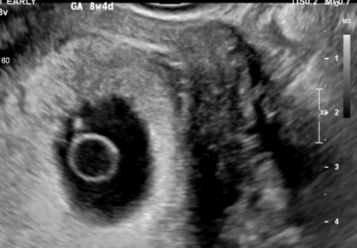 3 weeks pregnant ultrasound