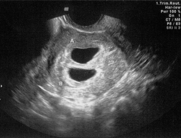 when do twins show up on ultrasound