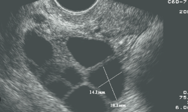 follicles in ovary ultrasound