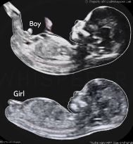 12 week ultrasound girl vs boy