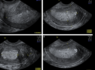 signs of endometrial cancer on ultrasound