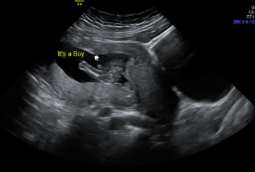 boy ultrasound with three lines