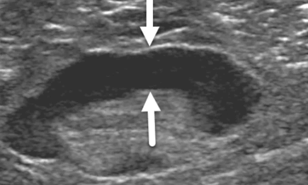 breast cancer ultrasound image