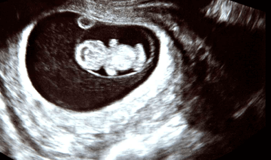 ultrasound at 9 weeks