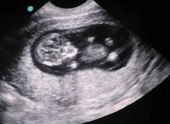 11 week ultrasound pictures