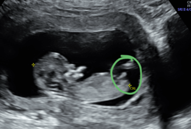 12 week ultrasound gender