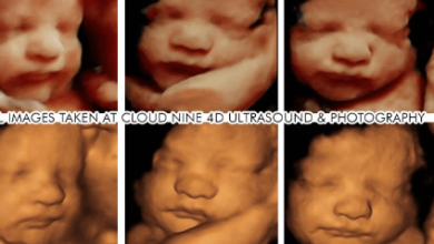 3d vs 4d ultrasound
