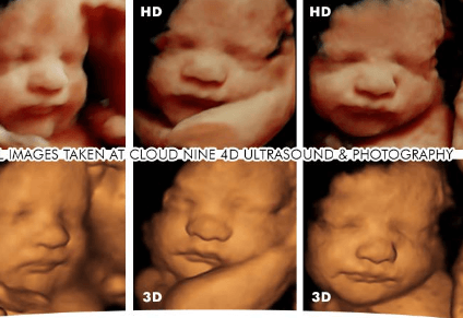 3d vs 4d ultrasound