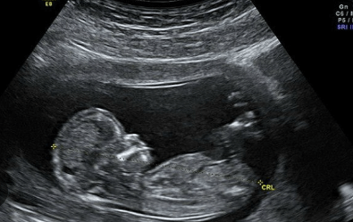 how to tell baby gender from ultrasound picture