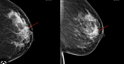 diagnostic mammogram and ultrasound