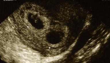 6 week ultrasound twins