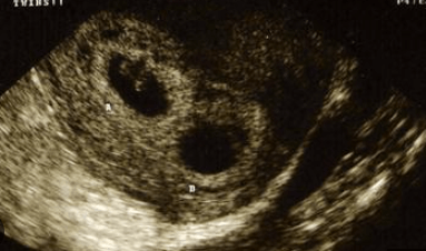 6 week ultrasound twins