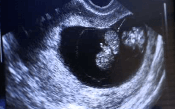 8 week ultrasound twins