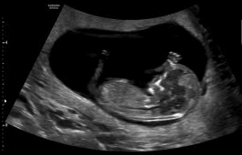 12 week ultrasound pictures