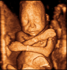 20 week 3d ultrasound