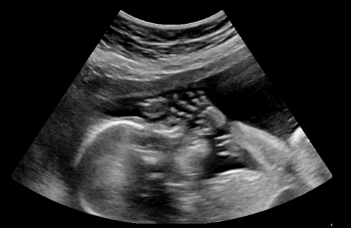 21 weeks pregnant ultrasound