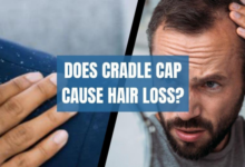 Cradle Cap