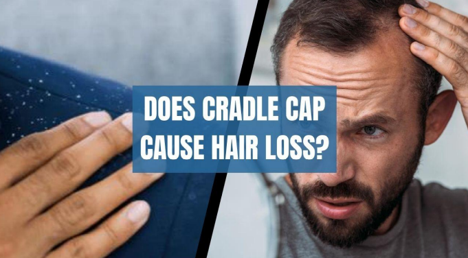 Cradle Cap